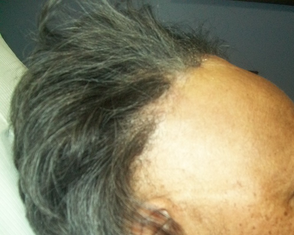 CCCA (Central Centrifugal Cicatricial Alopecia) symptoms ...