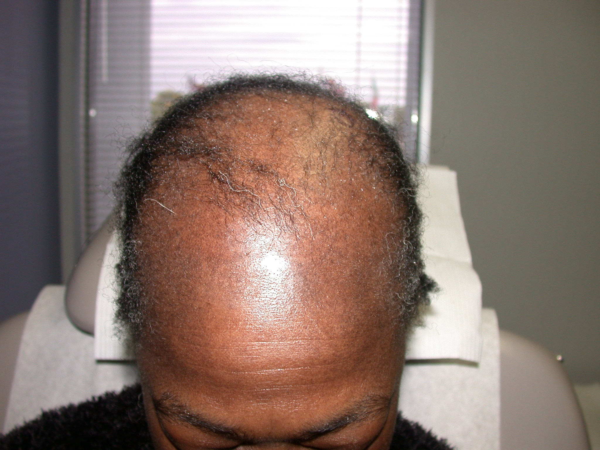 scarring alopecia Archives - Hair Restoration of the South