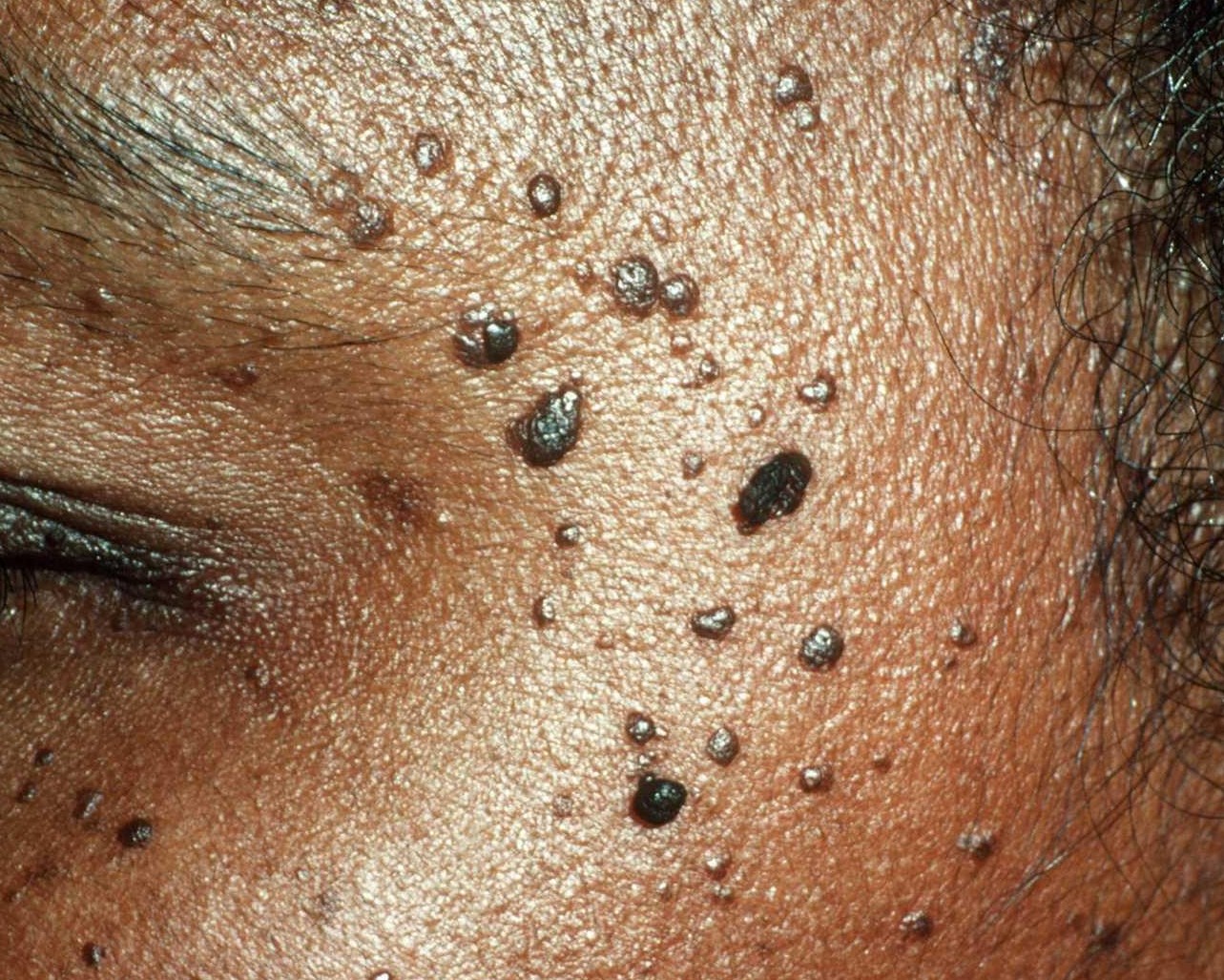 DPN Removal & Treatment (dermatosis papulosa nigra ...