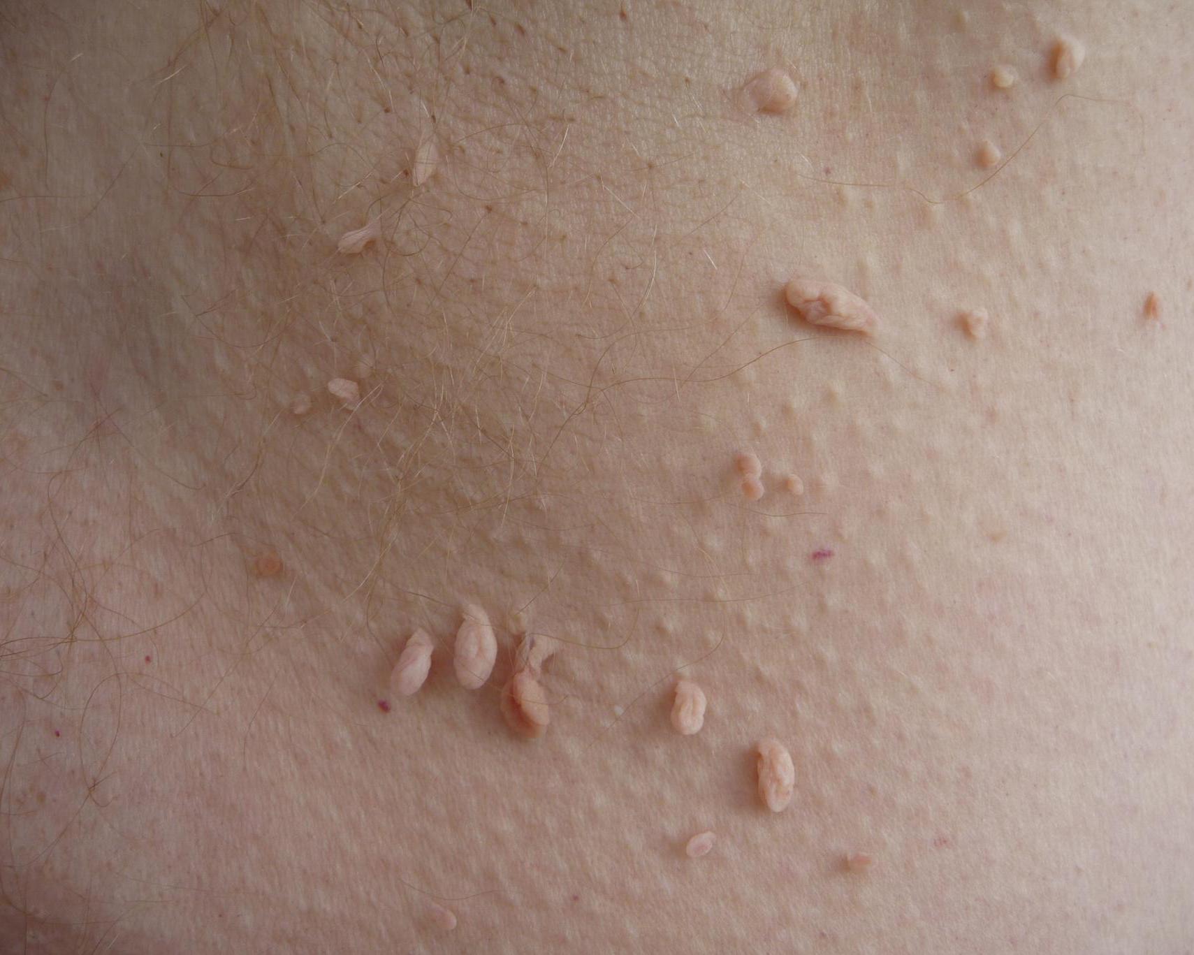 Genital Warts Skin Tags  newhairstylesformen2014.com